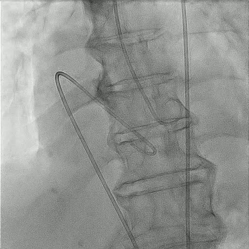 Fluoroscopic image from an invasive haemodynamic study showing catheters positioned in the heart