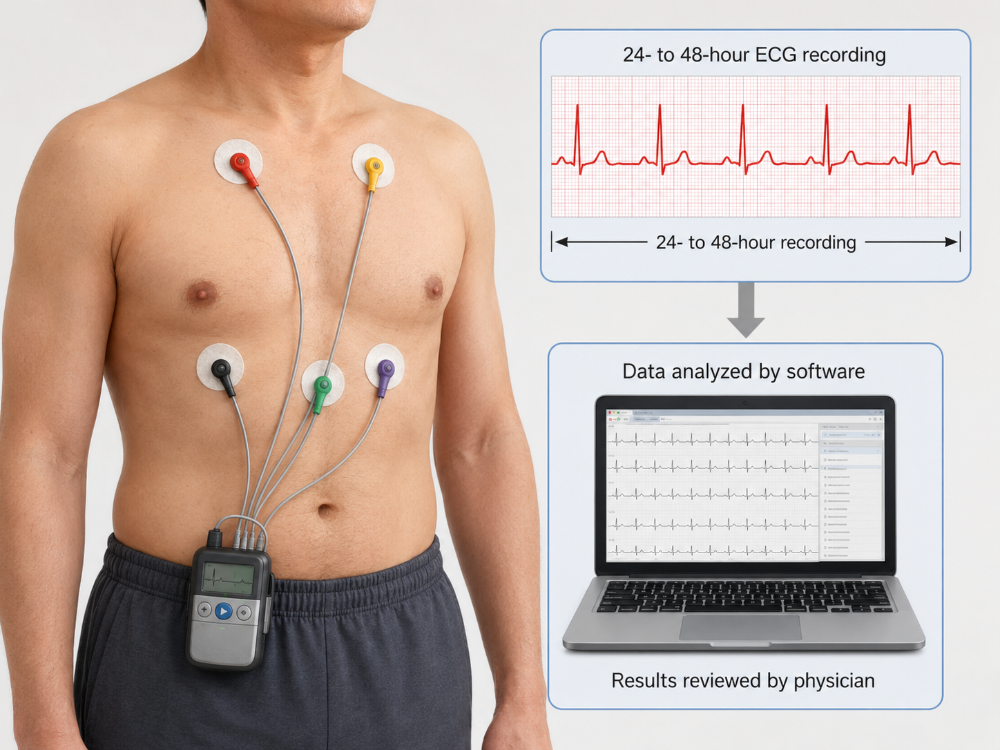 A Holter monitor worn on the waist with five chest electrodes, recording the heart rhythm for 24 to 48 hours before the data is analysed by software and reviewed by a physician